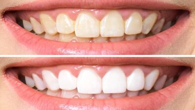 white teeth tips