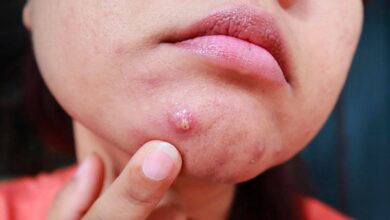 pimple remover tips