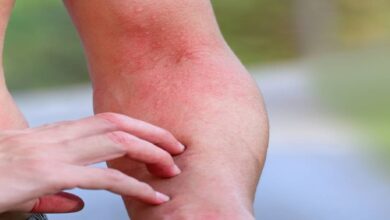 summer Itching problems