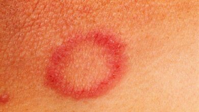 Thigh Ringworm Treatment