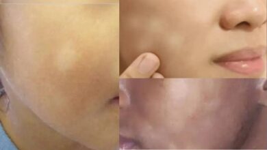 white spots on skin