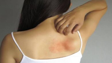 Heat Rash Home Remedies