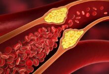 how to reduce cholesterol naturally