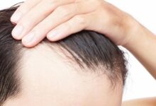how to stop hair loss