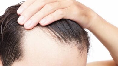 how to stop hair loss