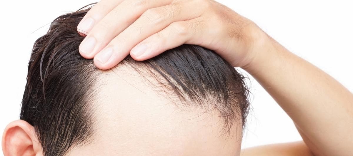 how to stop hair loss