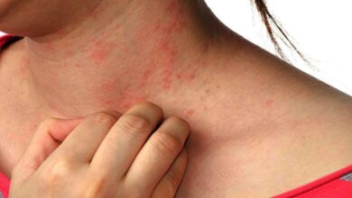 remedy pitta skin allergy