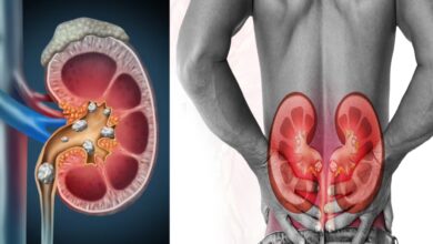 kidney stone treatment hindi