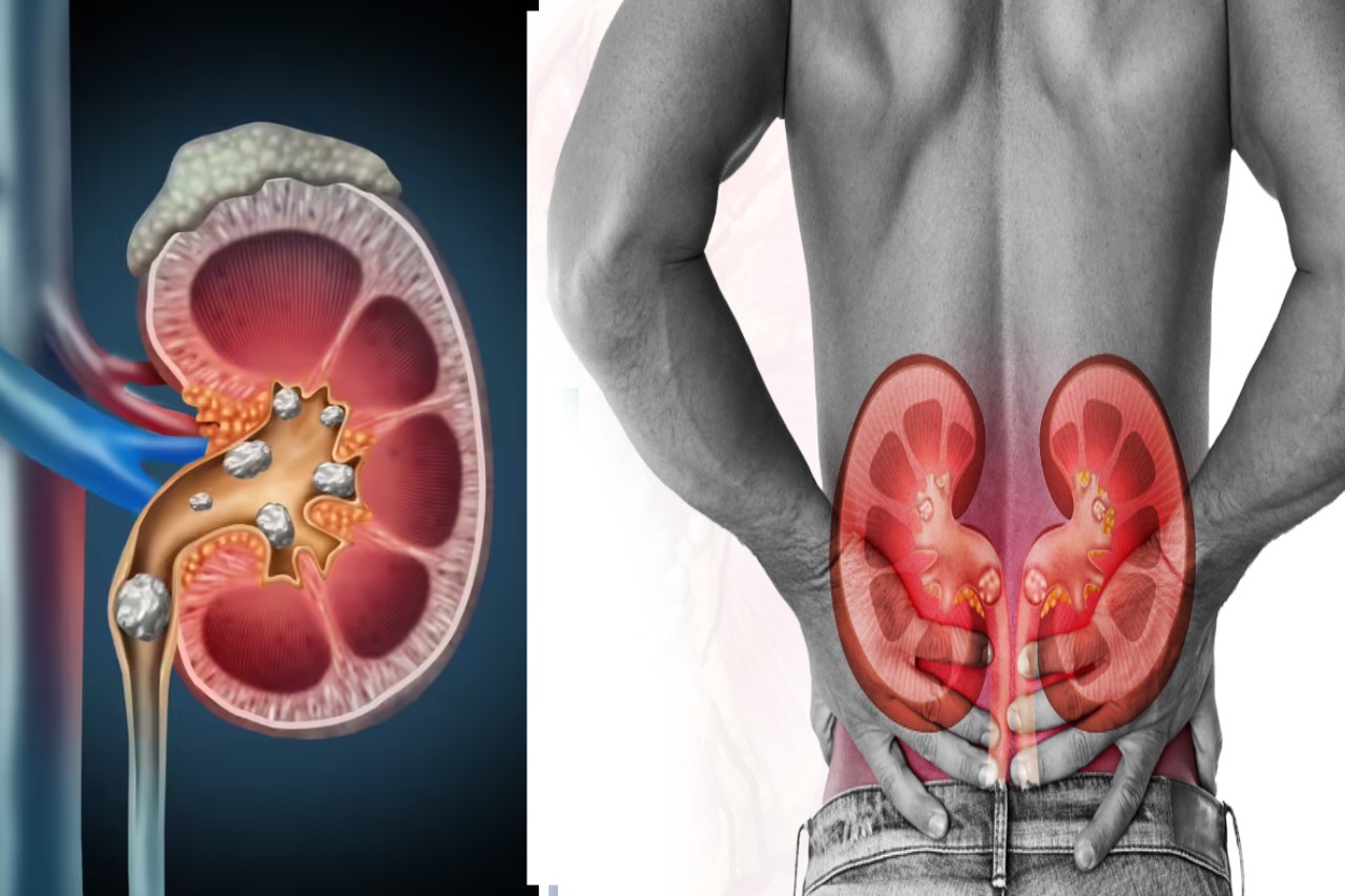 kidney stone treatment hindi