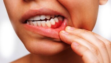 Bleeding gums remedies