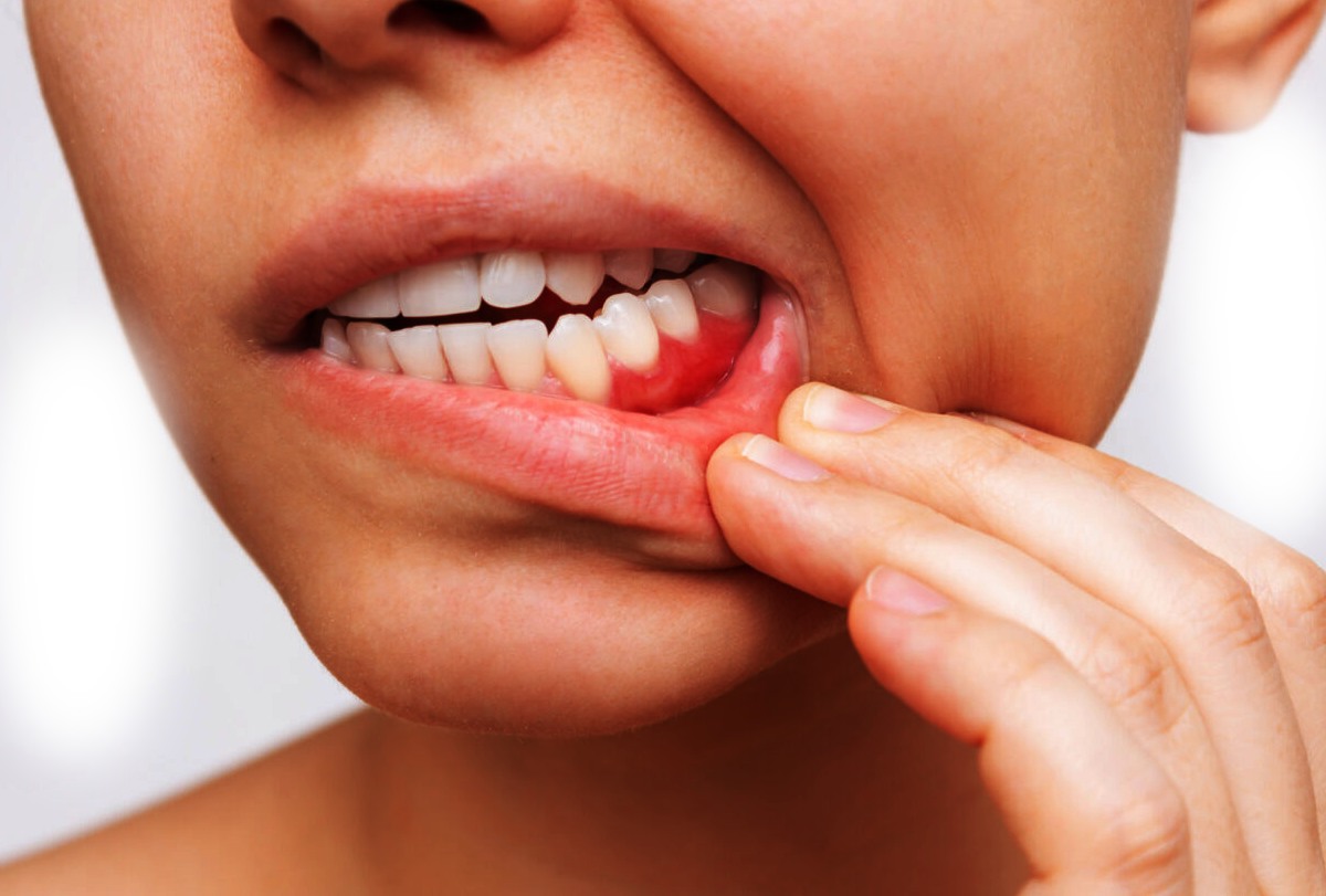 Bleeding gums remedies