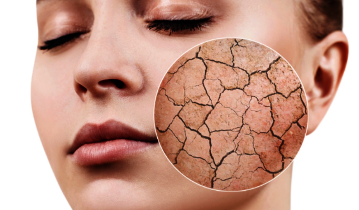 Winter Skin care tips
