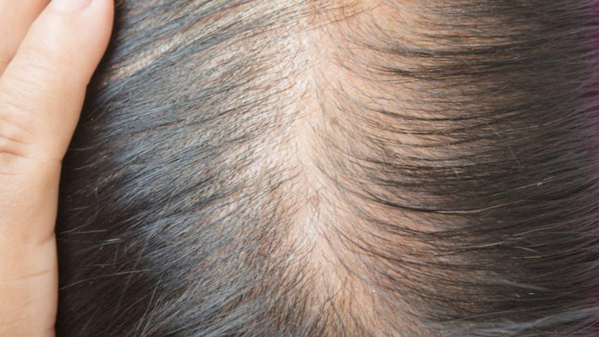 how to get rid of hair fall