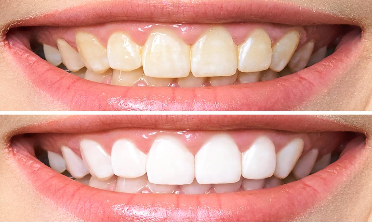 white teeth tips