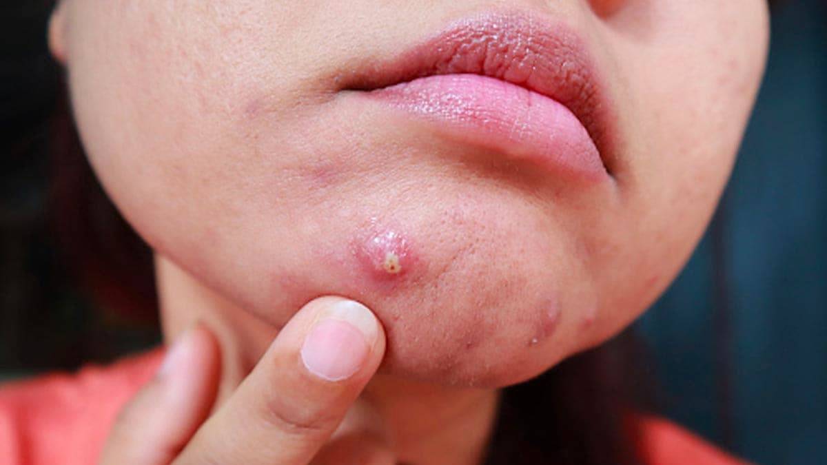 pimple remover tips