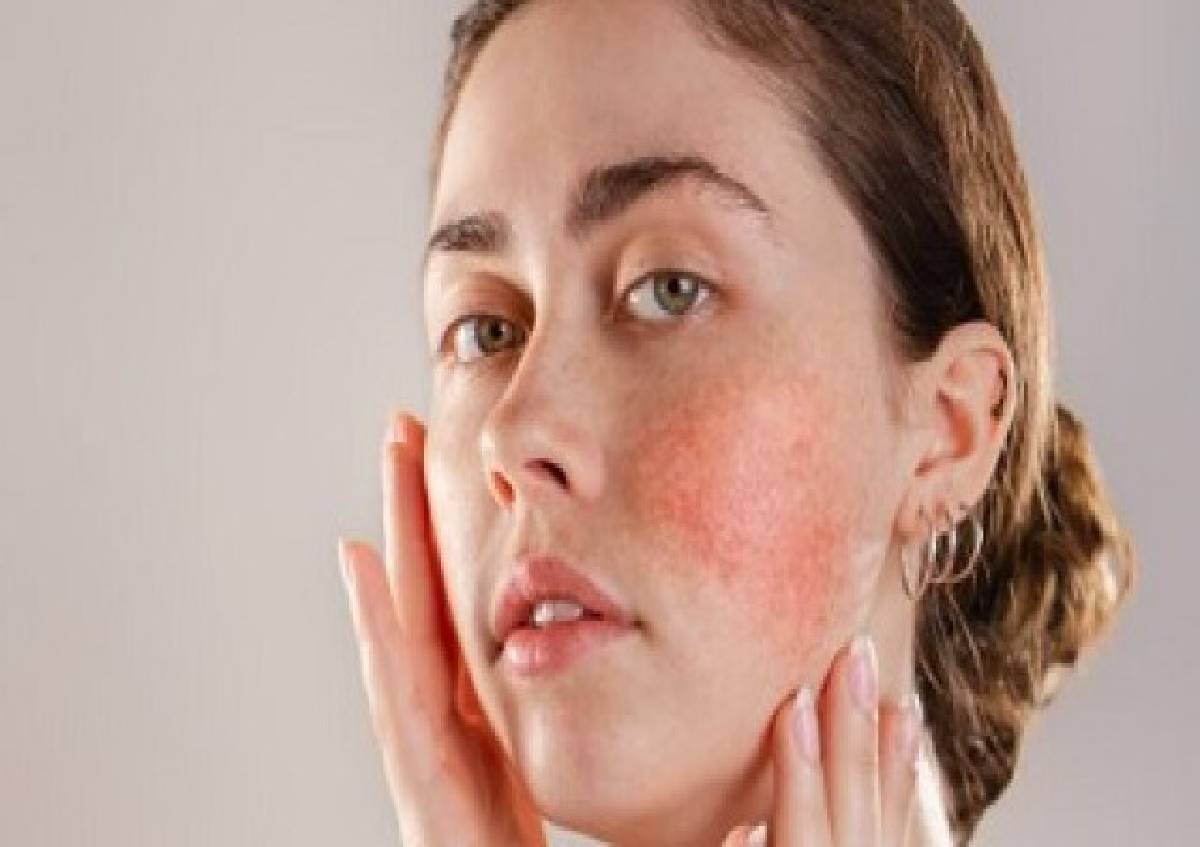Skin Home Remedy