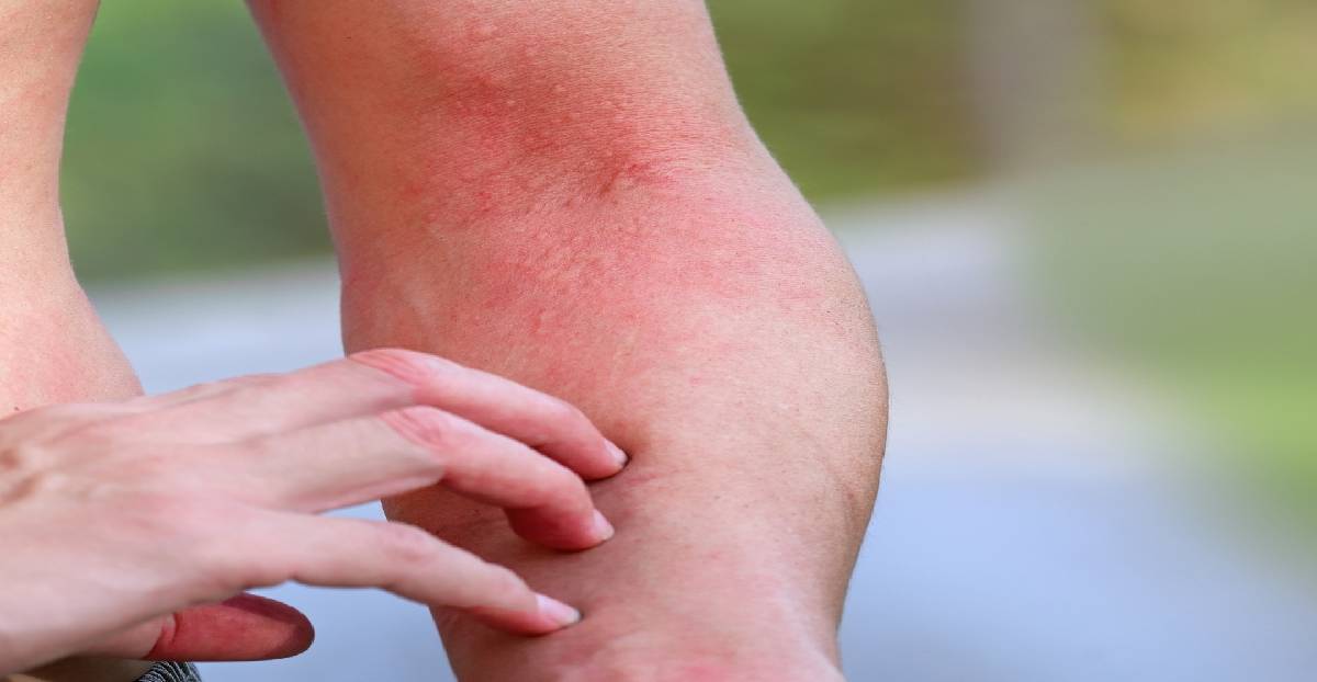 summer Itching problems