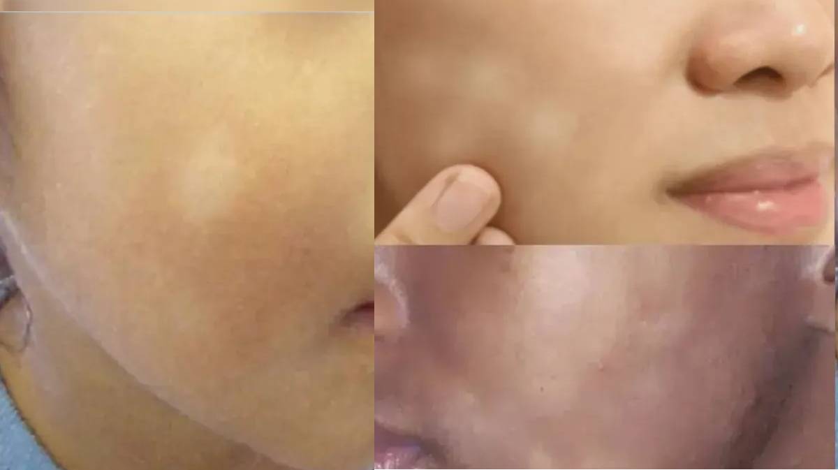 white spots on skin