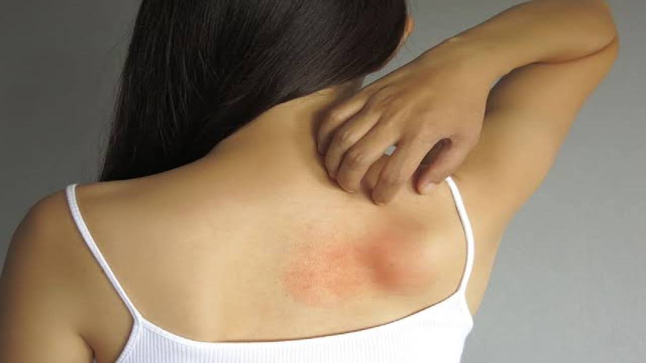 Heat Rash Home Remedies