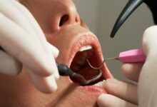 Dental Care Myths
