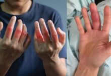 Swollen Hands Causes in Hindi