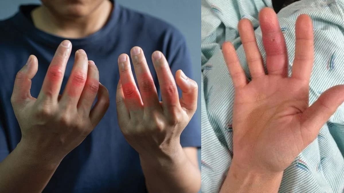 Swollen Hands Causes in Hindi