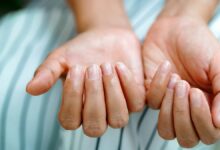 Brittle Nails Iron Deficiency