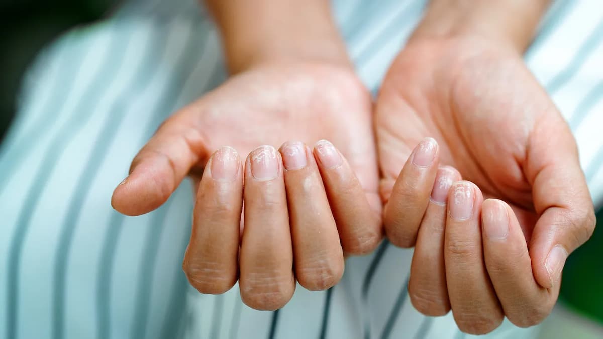 Brittle Nails Iron Deficiency